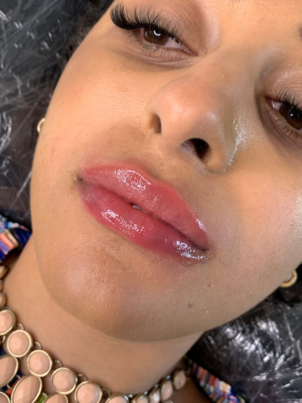 Lipfillers