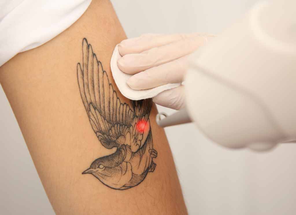 tattoo laser beautytrend