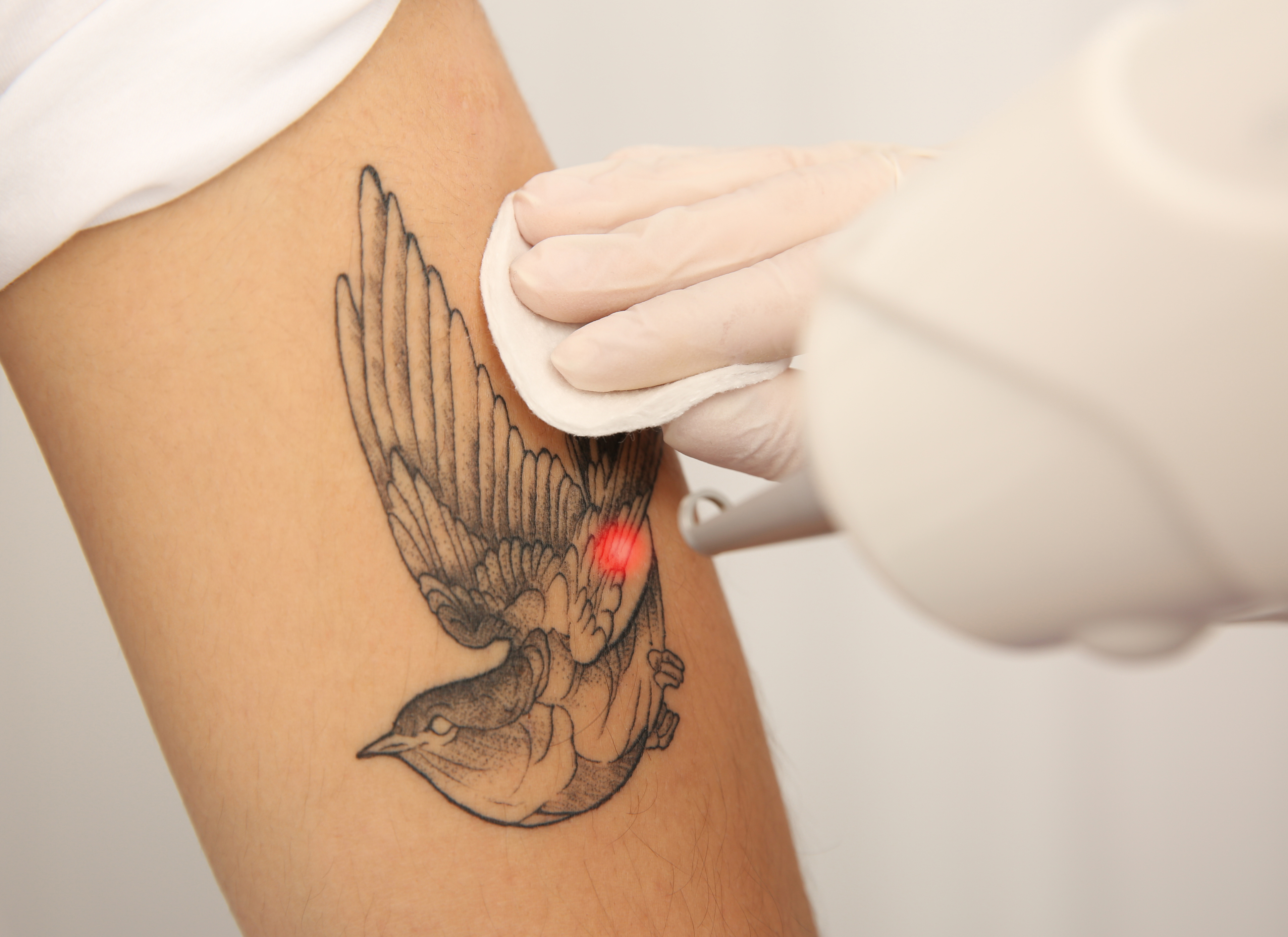 tattoo laser beautytrend