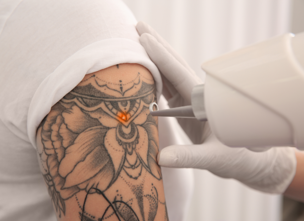 tattoo removal maarssen utrecht