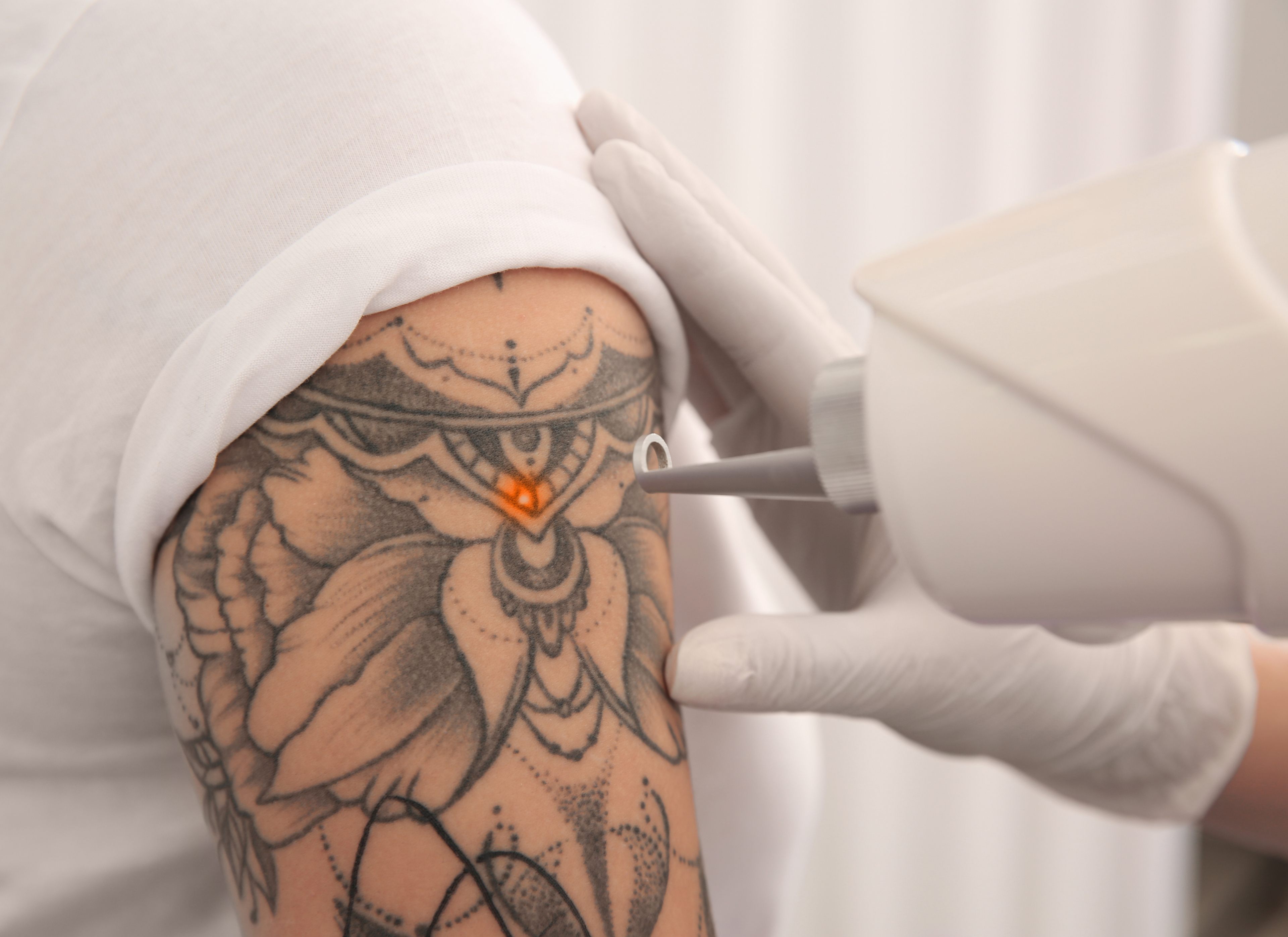 tattoo removal maarssen utrecht